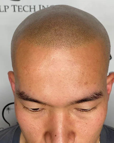 Scalp micropigmentation result, front hairline
