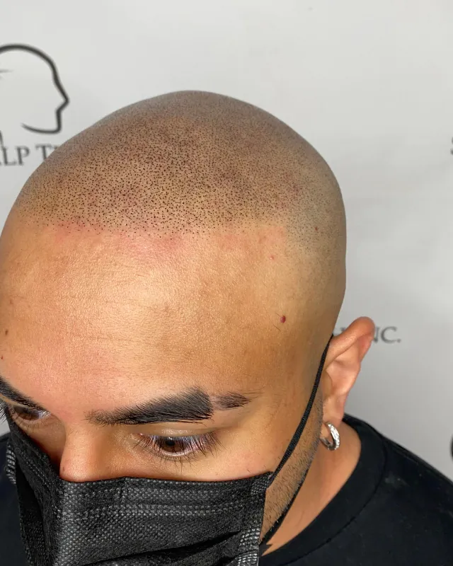 Scalp micropigmentation result, receding hairline