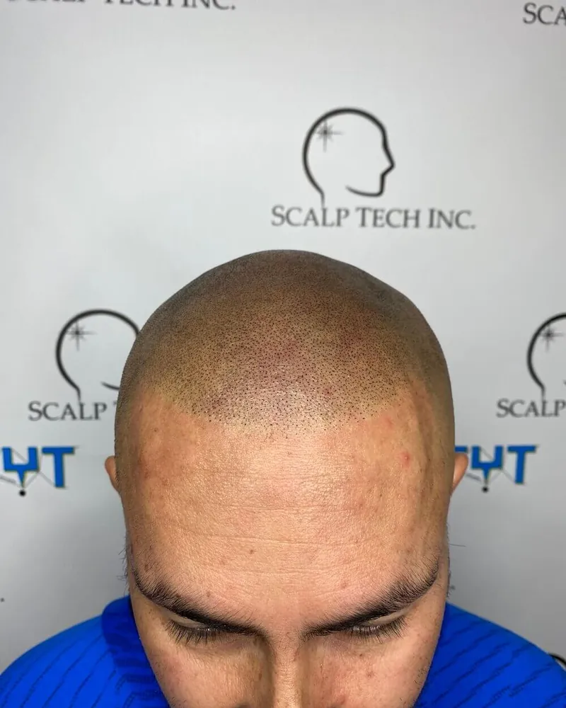 Scalp micropigmentation result at Scalp Tech Inc.