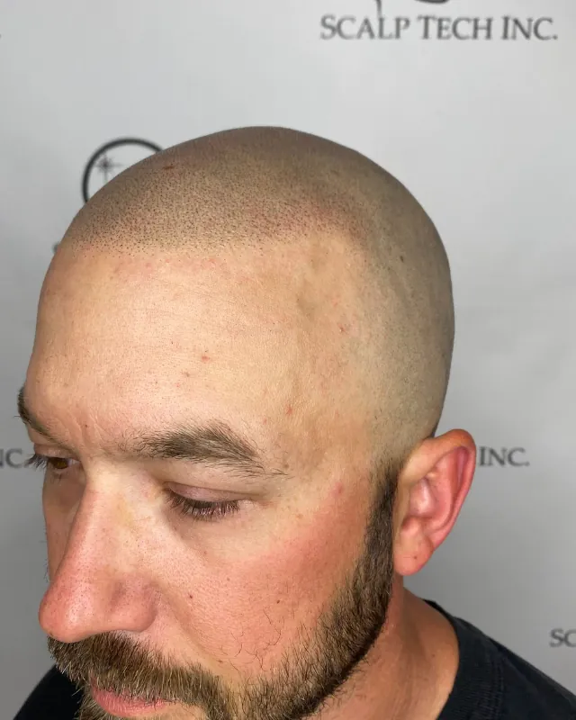 Scalp micropigmentation result, side view