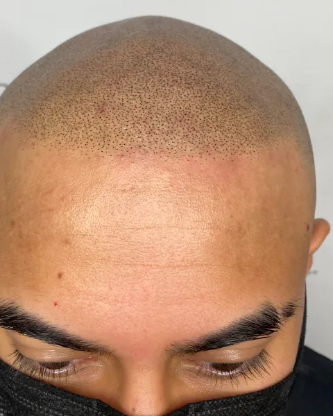 Scalp micropigmentation result at Scalp Tech Inc.