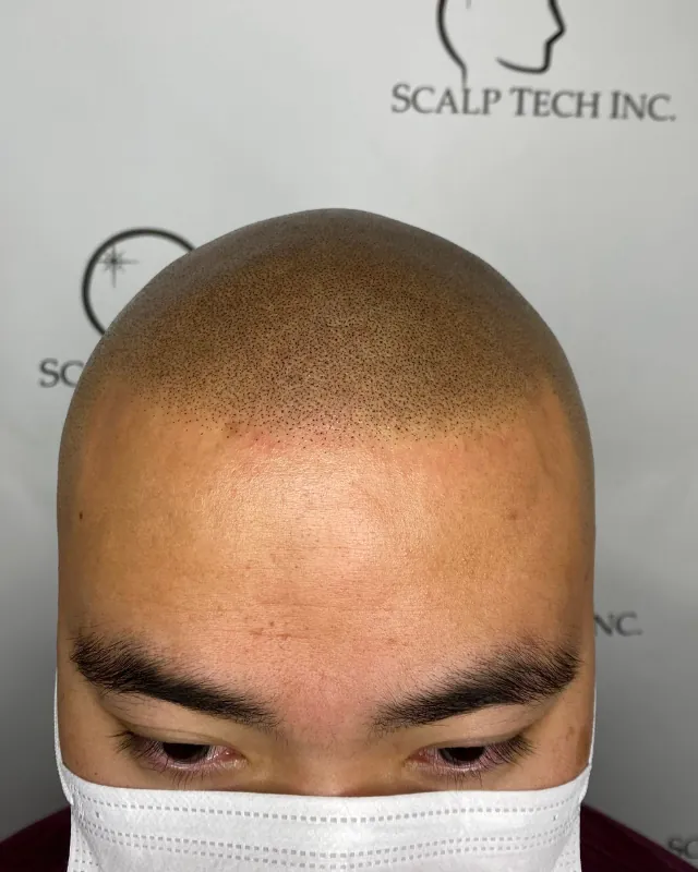 Scalp micropigmentation result, crown