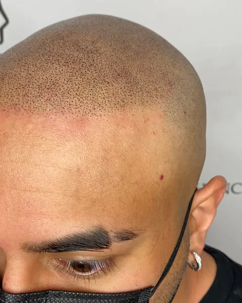 Scalp micropigmentation result, side profile