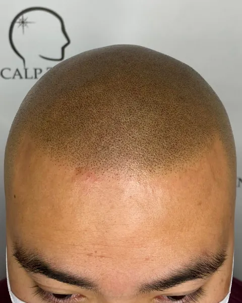Scalp micropigmentation result at Scalp Tech Inc.