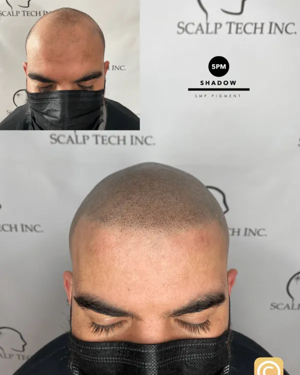 Scalp micropigmentation result, full scalp