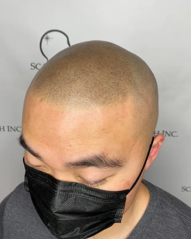 Scalp micropigmentation result, hairline