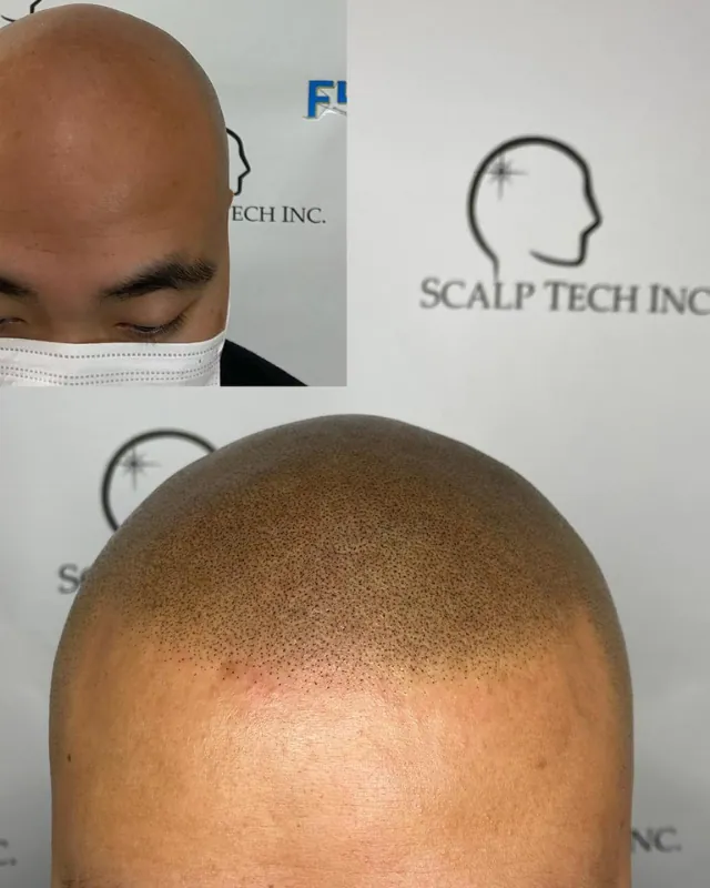 Scalp micropigmentation result at Scalp Tech Inc.