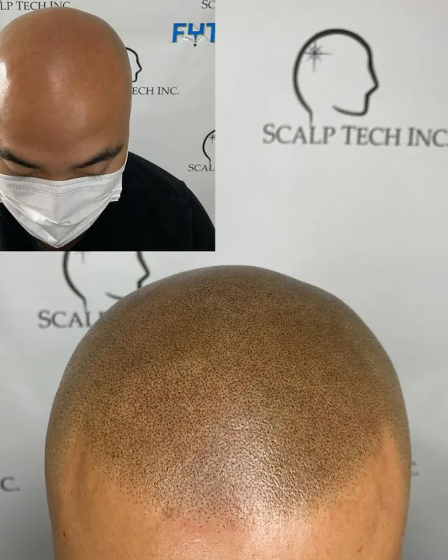 Scalp micropigmentation result, front